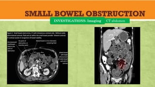 SMALL BOWEL OBSTRUCTION
INVESTIGATIONS- Imaging CT abdomen
 