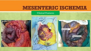 MESENTERIC ISCHEMIA
Clinical Features
 