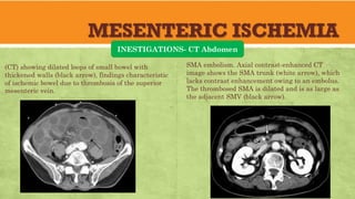 MESENTERIC ISCHEMIA
INESTIGATIONS- CT Abdomen
SMA embolism. Axial contrast-enhanced CT
image shows the SMA trunk (white arrow), which
lacks contrast enhancement owing to an embolus.
The thrombosed SMA is dilated and is as large as
the adjacent SMV (black arrow).
(CT) showing dilated loops of small bowel with
thickened walls (black arrow), findings characteristic
of ischemic bowel due to thrombosis of the superior
mesenteric vein.
 