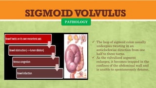SIGMOIDVOLVULUS
PATHOLOGY
✓ The loop of sigmoid colon usually
undergoes twisting in an
anticlockwise direction from one
half to three turns.
✓ As the volvulized segment
enlarges, it becomes trapped in the
confines of the abdominal wall and
is unable to spontaneously detorse.
 
