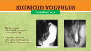 SIGMOIDVOLVULUS
INVESTIGATIONS
✓ Barium Enema:
- Bird’s beak appearance
- Ace of spade sign
✓ Upper end of Barium
column tapers into spirally-
twisted distal sigmoid colon
 