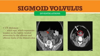 SIGMOIDVOLVULUS
INVESTIGATIONS
✓ CT Abdomen:
- whirl sign, which represents
tension on the tightly twisted
mesocolon by the afferent and
efferent limbs of the dilated colon.
 