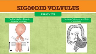 SIGMOIDVOLVULUS
TREATMENT
Paul-Mickulicz Double
barrel Colostomy
Hartman’s temporary End-
Colostomy
 