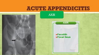 ACUTE APPENDICITIS
AXR
 