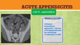 ACUTE APPENDICITIS
CECT- ABDOMEN
 