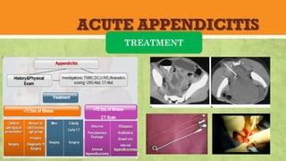 ACUTE APPENDICITIS
TREATMENT
 