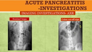 ACUTE PANCREATITIS
-INVESTIGATIONS
IMAGING INVESTIGATIONS- AXR
Sentinel loops Colon cut-off sign
 