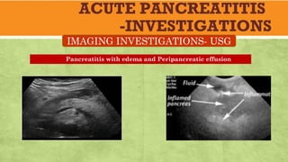 ACUTE PANCREATITIS
-INVESTIGATIONS
IMAGING INVESTIGATIONS- USG
Pancreatitis with edema and Peripancreatic effusion
 