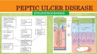 PEPTIC ULCER DISEASE
ETIOPATHOGENESIS
 