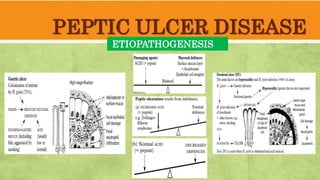 PEPTIC ULCER DISEASE
ETIOPATHOGENESIS
 