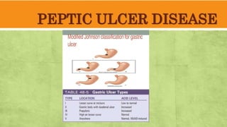 PEPTIC ULCER DISEASE
 