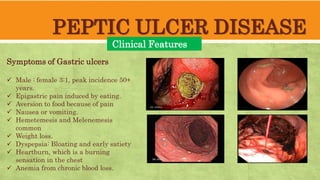 PEPTIC ULCER DISEASE
Clinical Features
Symptoms of Gastric ulcers
Male : female 3:1, peak incidence 50+
years.
Epigastric pain induced by eating.
Aversion to food because of pain
Nausea or vomiting.
Hemetemesis and Melenemesis
common
Weight loss.
Dyspepsia: Bloating and early satiety
Heartburn, which is a burning
sensation in the chest
Anemia from chronic blood loss.
 