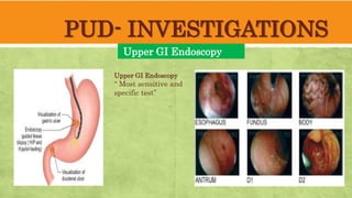 PUD- INVESTIGATIONS
Upper GI Endoscopy
Upper GI Endoscopy
“ Most sensitive and
specific test”
 