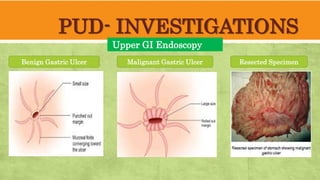 PUD- INVESTIGATIONS
Upper GI Endoscopy
Benign Gastric Ulcer Malignant Gastric Ulcer Resected Specimen
 