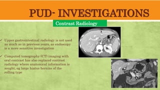 PUD- INVESTIGATIONS
Contrast Radiology
Upper gastrointestinal radiology is not used
as much as in previous years, as endoscopy
is a more sensitive investigation
Computed tomography (CT) imaging with
oral contrast has also replaced contrast
radiology where anatomical information is
sought, eg large hiatus hernias of the
rolling type
 