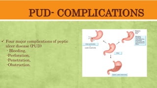PUD- COMPLICATIONS
Four major complications of peptic
ulcer disease (PUD)
- Bleeding,
-Perforation,
-Penetration,
-Obstruction.
 