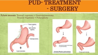 PUD- TREATMENT
- SURGERY
Pyloric stenosis: Truncal vagotomy + Gastrojejunostomy
Truncal Vagotomy + Pyloroplasty
 