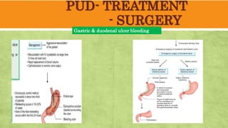 PUD- TREATMENT
- SURGERY
Gastric & duodenal ulcer bleeding
 