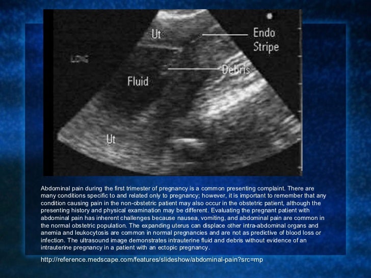 Abdominal pain in pregnancy Abdominal pain in pregnancy