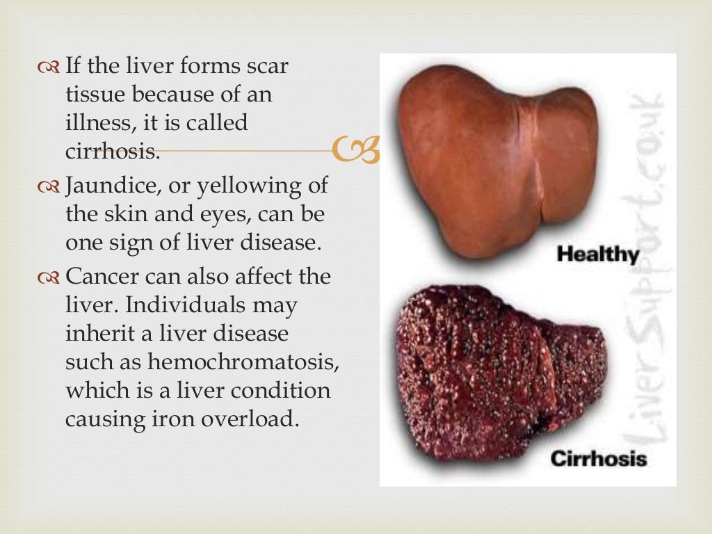 The Hidden Danger Of Abdominal Pain Liver Enlargement Revealed - foz5zue