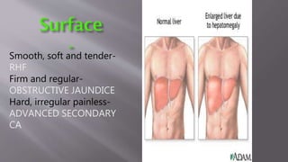 Smooth, soft and tender-
RHF
Firm and regular-
OBSTRUCTIVE JAUNDICE
Hard, irregular painless-
ADVANCED SECONDARY
CA
 