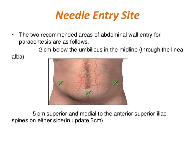 paracentesis