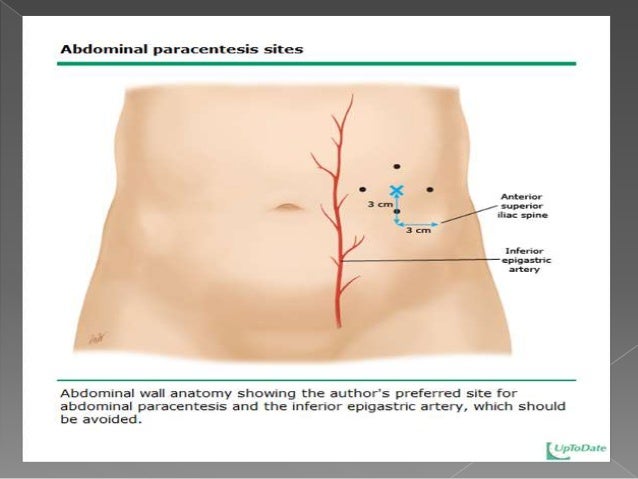 paracentesis