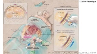 Wong C. L., Holroyd-Leduc J., Thorpe K. E., et al. (2008), JAMA, 299 (10), pp. 1166-1178
“Z tract” technique
 