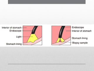 Comprehensive Guide to Abdominal Paracentesis and OGDS Procedures | PPTX