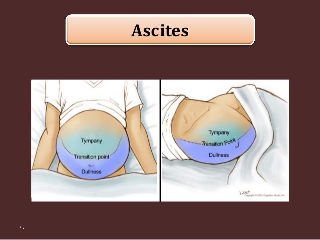 Abdominal percussion [2015]