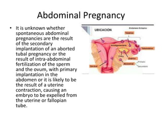 Abdominal pregnancy and IVF | PPTX