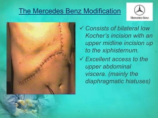 Abdominal surgery | PPTX