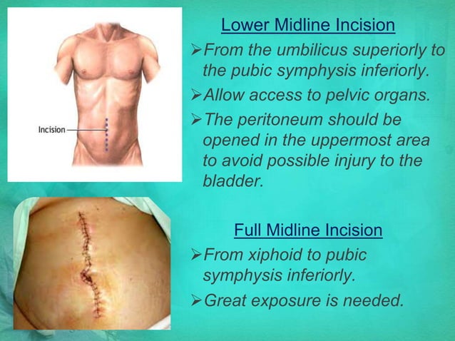 Abdominal Surgery PPT abdominal-surgery-ppt