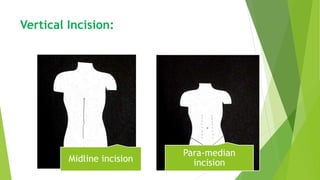 Vertical Incision:
Midline incision
Para-median
incision
 