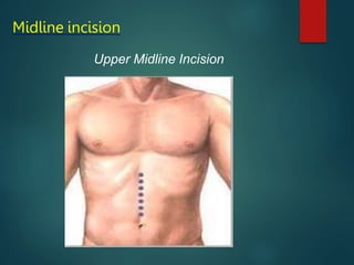 Midline incision
Upper Midline Incision
 