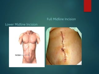Lower Midline Incision
Full Midline Incision
 