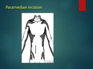 Paramedian incision
 