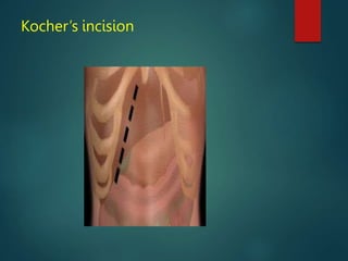 Kocher’s incision
 