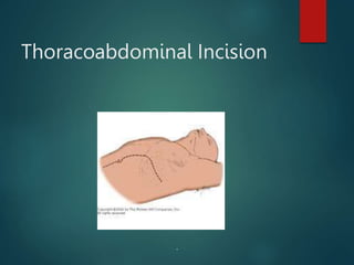 Thoracoabdominal Incision
.
 