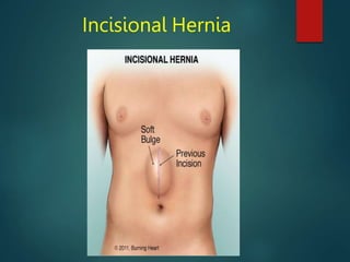 Incisional Hernia
 