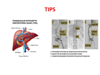 approach to ascites and abdominal swelling | PPTX