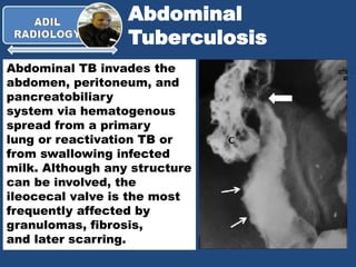 Abdominal
Tuberculosis
Abdominal TB invades the
abdomen, peritoneum, and
pancreatobiliary
system via hematogenous
spread from a primary
lung or reactivation TB or
from swallowing infected
milk. Although any structure
can be involved, the
ileocecal valve is the most
frequently affected by
granulomas, fibrosis,
and later scarring.
 