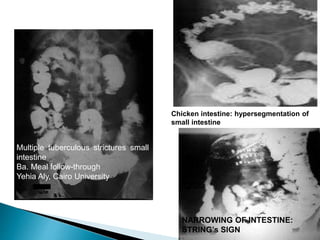 GASTROINTESTINAL TUBERCULOSIS ABDOMINAL TUBERCULOSIS | PPTX