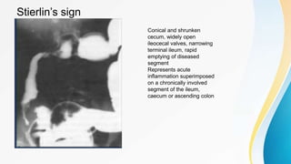 ABDOMINAL TB -ILEOCAECAL and gastrointestinal.pptx