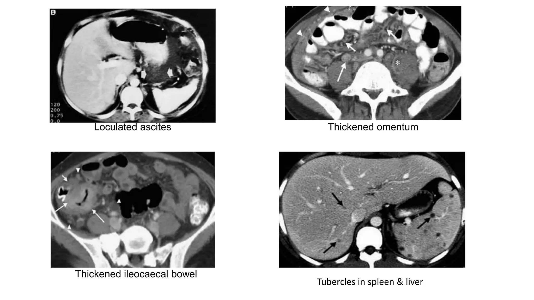 Abdominal Tuberculosis-Management | PPTX