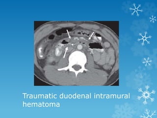 Traumatic duodenal intramural
hematoma
 