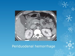 Periduodenal hemorrhage
 