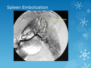 Spleen Embolization
 
