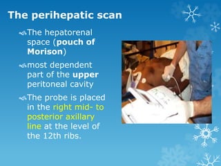 The perihepatic scan
The hepatorenal
space (pouch of
Morison)
most dependent
part of the upper
peritoneal cavity
The probe is placed
in the right mid- to
posterior axillary
line at the level of
the 12th ribs.
 
