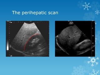 The perihepatic scan
 